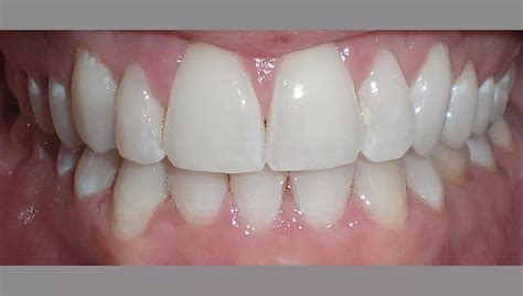 Invisalign → Stor erfaring og fair priser .